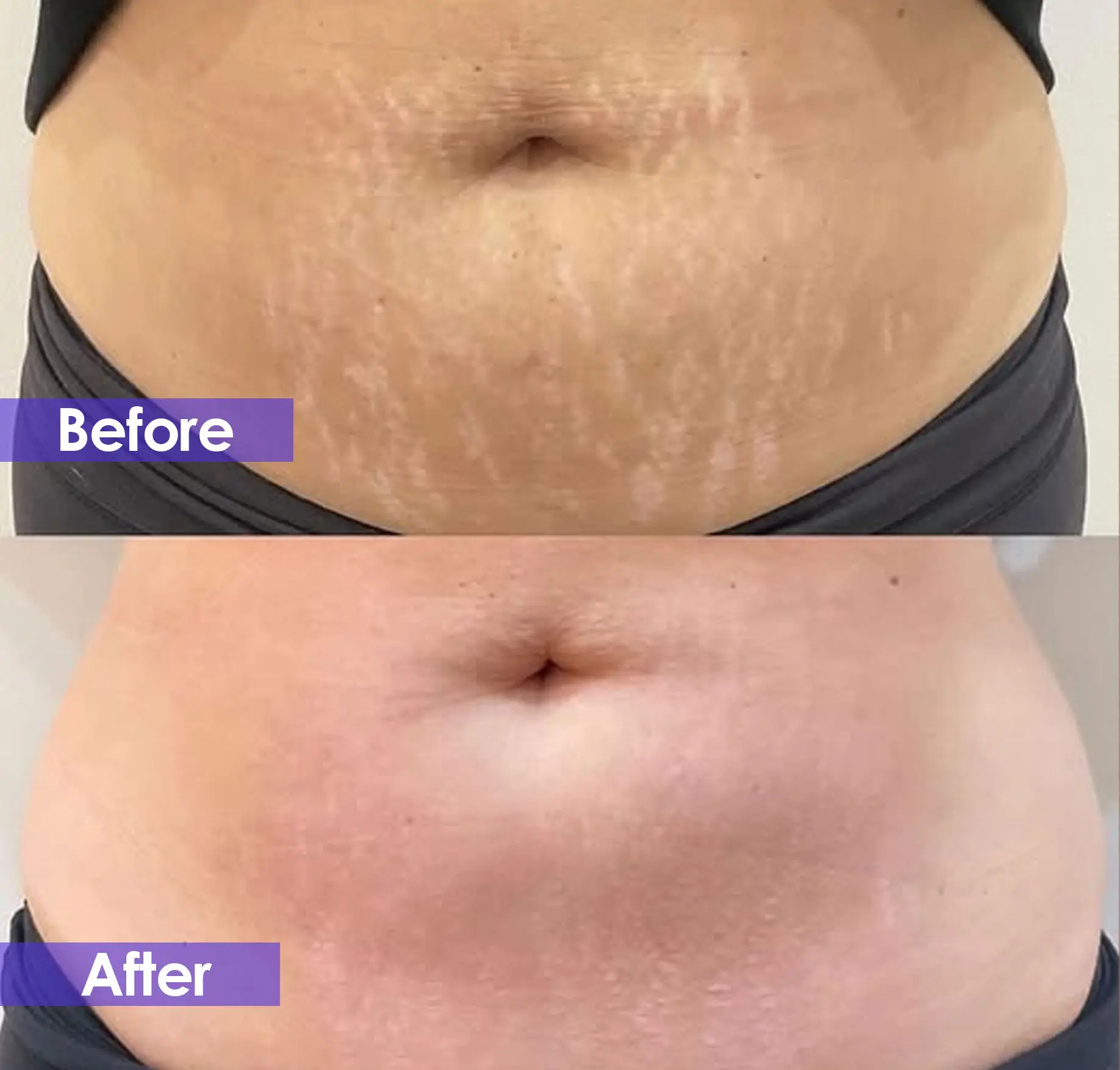 Stretch mark removal before and after - co2 laser